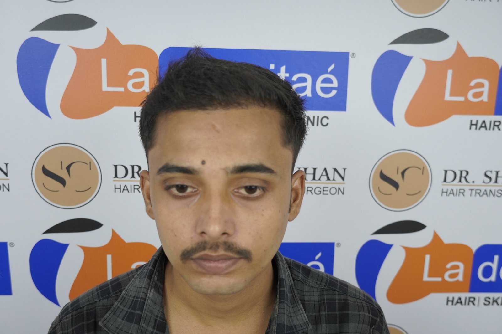 Ashis Yadav After Hair Transplant